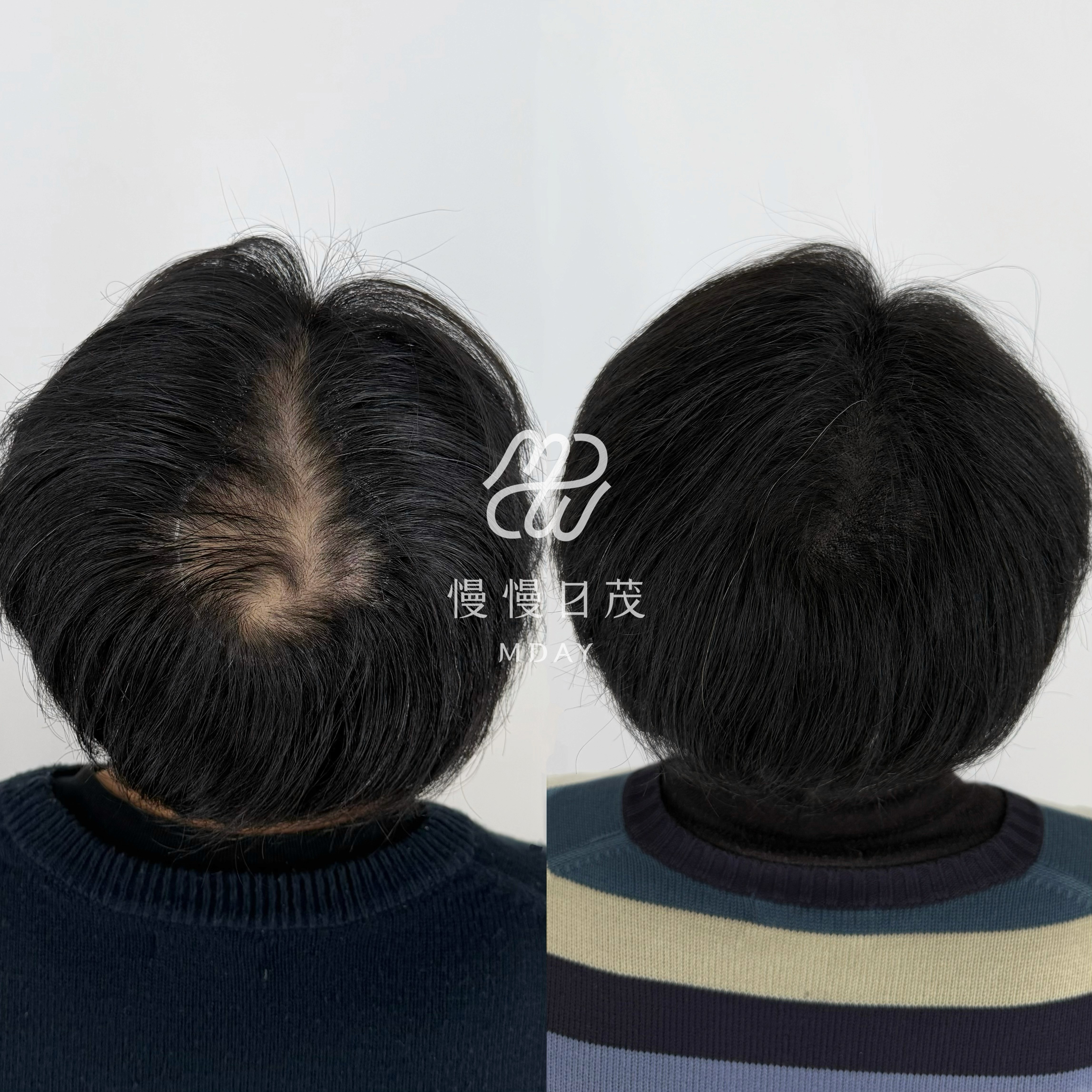 湯圓哥 Before After 對比